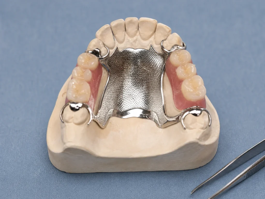 Estructura metálica y piezas dentales de una prótesis combinada